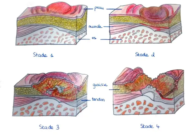 Figure 1: Différents stades cliniques d'escarres  