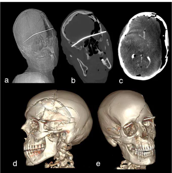 Figure 1 : Plaie transfixiante intracérébrale temporale gauche à l’origine du décès   