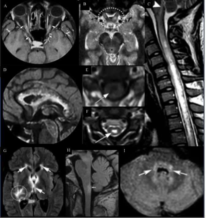 Figure 11 Exemples de lésions IRM de NMOSD. A. Hypersignaux T1 postérieurs des 2 nerfs optiques  (flèches) après injection de gadolinium