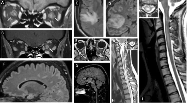 Figure 12 Exemples de lésions IRM de MOGAD. A &amp; B. Coupes T1 coronales montrant un réhaussement de la  portion intra orbitaire des nerfs optiques associé à un réhaussement de la gaine du nerf optique et de la zone  péri-neurale chez un sujet avec une N