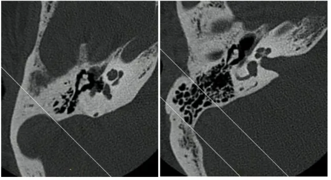 Figure  2. Classification de la pneumatisation péri-sigmoïdienne selon Han et al. (38)