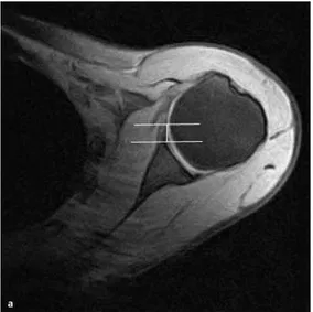 Figure 10: IRM , coupe axiale de l’épaule.