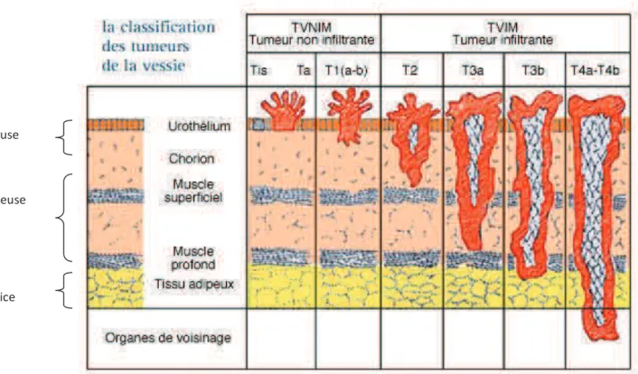 Figure 1: Classification des stades des tumeurs de la vessie (repris de Pointreau et al.) [34] 