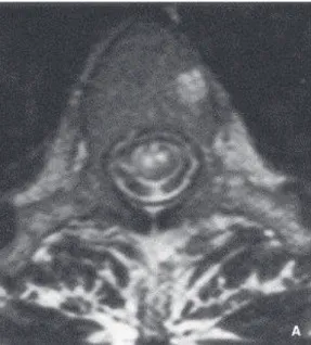Fig  7  :  IRM  médullaire  séquence  T2  :  infarctus  médullaire  antérieur  bilatéral  et  infarctus du corps vertébral gauche.