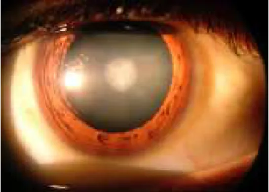 Figure 8 : cataracte sous-capsulaire postérieure (ICRP, 2013) 