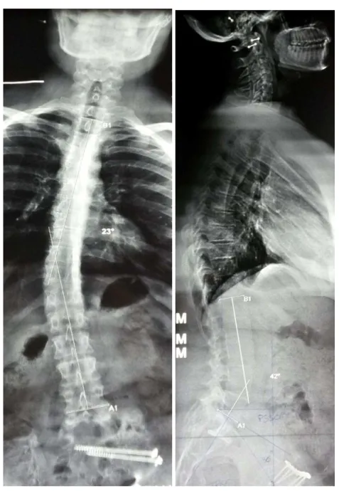 Figure 19 : Patiente présentant une fracture classée  Tile C 3.3 avec une incidence pelvienne mesurée  à 66°, une pente sacrée à 30°, une rétroversion pelvienne avec version pelvienne à 36°, une lordose lombaire  à 42 ° pour une lordose théorique à 56°, un