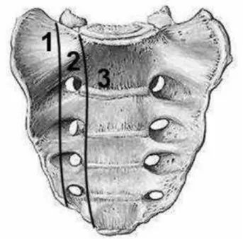 Figure 3 : Classification topographiques des lésions du sacrum au sein de l'anneau  pelvien selon de Denis [16] 