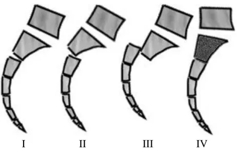 Figure 4 : Classification des lésions du sacrum isolé selon Roy Camille   modifiée par Strange Vognsen [17] 