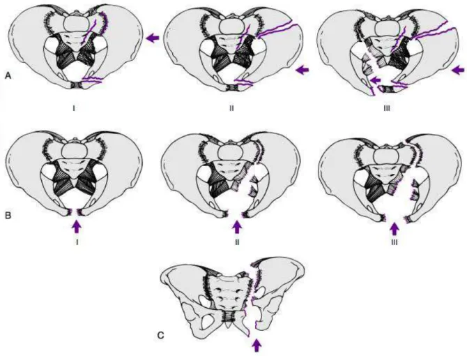 Figure 5 : Classification des lésions de l'anneau pelvien en fonction du mécanisme de  survenue selon Young et Burgess [19] 