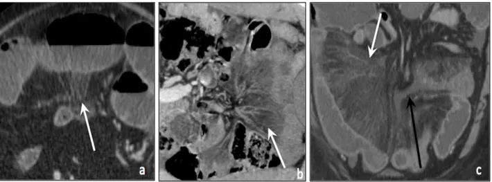 Figure 6 : Infiltration mésentérique 