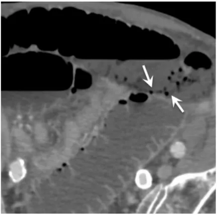 Figure 8 : Pneumatose pariétale 