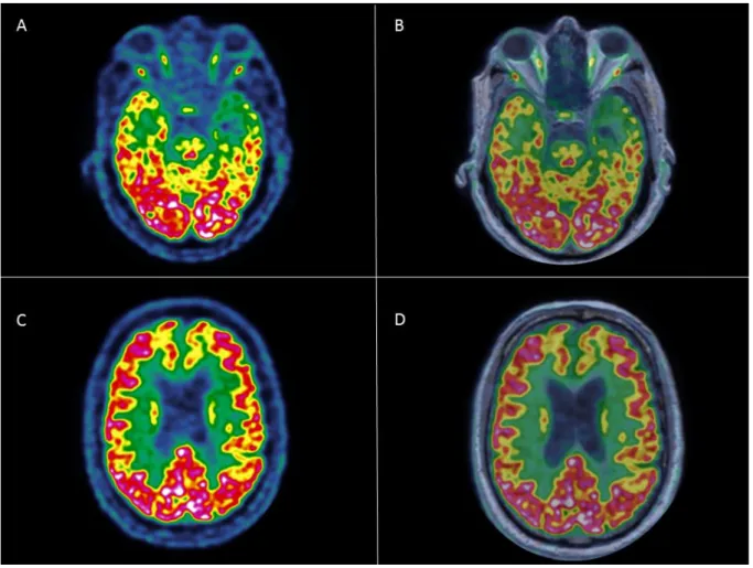 Figure 12. Patient MA diagnostiqué comme démence sémantique en TEP-IRM :   TEP-FDG (A,C) et fusion TEP-FDG et 3DT1 (B, D)