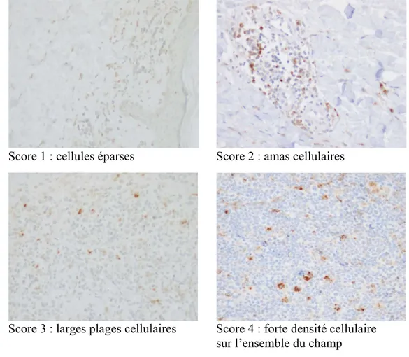 Figure 9. Illustration du score utilisé pour quantifier la densité des infiltrats 