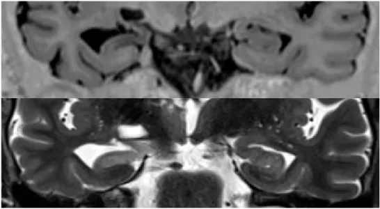 Figure 7 : Sclérose hippocampique droite, en T1 IR (image supérieure) et T2 TSE (image  inférieure) : Atrophie hippocampique, hyposignal T1 et hypersignal T2 hippocampique, perte des 