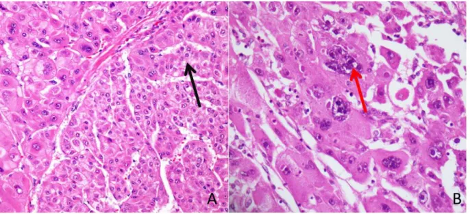 Figure 5 : Grades de différenciation du CHC. 