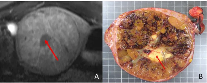 Figure  12 :    IRM  hépatique  (A)  et  photo  macroscopique  (B)  d’une  même  tumeur,  un  CHC  macrotrabéculaire massif