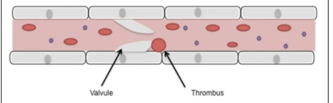 Figure 7 - Thrombose sur valvule  On peut distinguer des facteurs prédisposant (7) :   