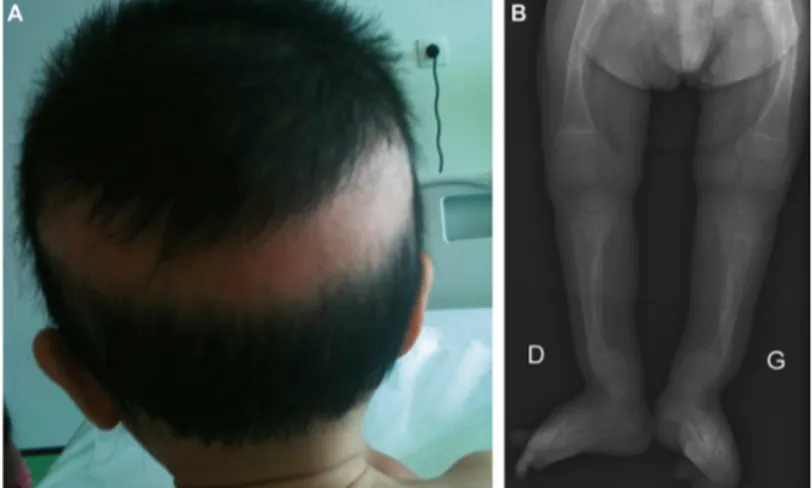 Figure 5 : Rachitisme par mutation du VDR, caractérisé cliniquement par une alopécie  (A) et par une atteinte osseuse sévère avec nombreuses fractures (B) (15)