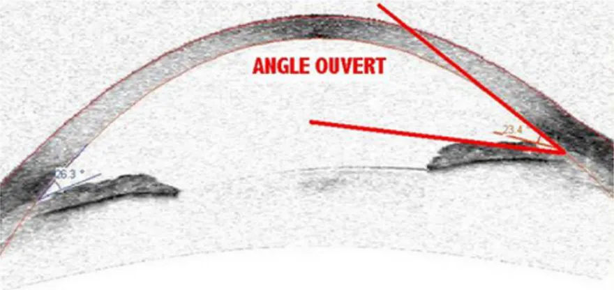 Figure 14 : Examen en tomographie de cohérence optique d’un glaucome à angle ouvert  22