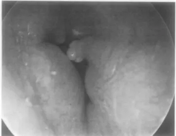 Figure  15.  Occlusion  quasi  totale  (90%)  du  canal  auditif  externe  gauche  dûe  à  de  multiples exostoses.(14) 