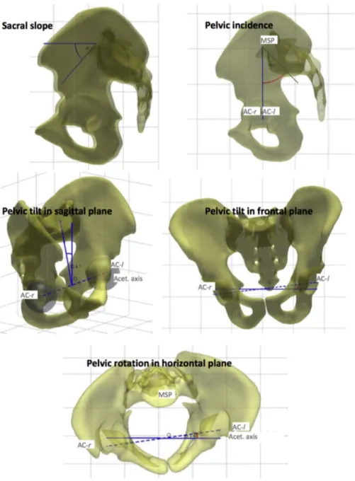 Fig. 3.Pelvic parameters, including sacral slope (SS), pelvic incidence (PI), pelvic tilt in the sagittal plane (PT-s), pelvic tilt in the frontal plane (PT-f) and pelvic rotation in the horizontal plane (PR)