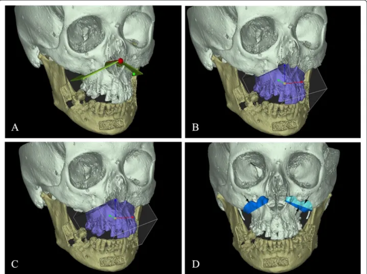 Fig. 2 a Generation of the plane for the virtual maxillary ’ s osteotomy (b) Segmentation of 3-D bone segments corresponding to the Le Fort I osteotomy (c) Repositioning of the maxillary osteotomized segment according to the planned movements (d) Generatio