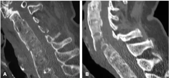 Fig. 4. Imaging classiﬁcation of the cervical fractures: (A) transdiscal, and (B) transcorporeal