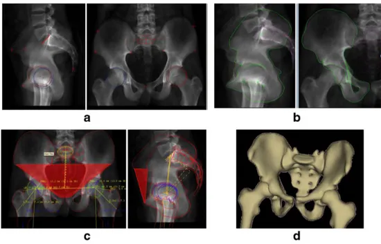 Fig. 1 Process of the 3D reconstruction of the Pelvis: a) selection of anatomical landmarks, b) adjustment of the 3D model, c) calculation of 3D radiological parameters, d) example of 3D reconstruction of the pelvis