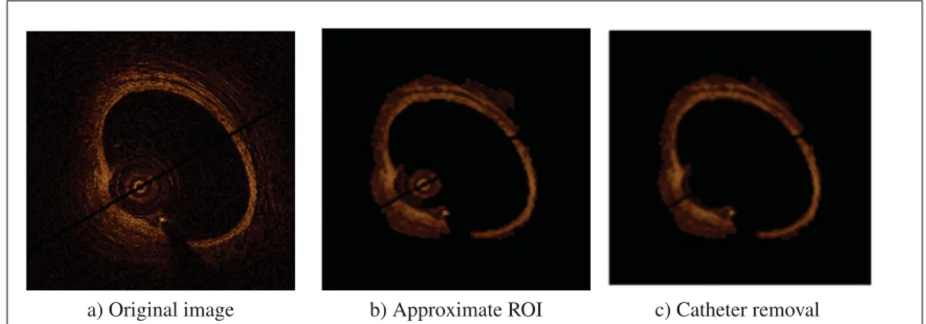 Figure 4.1 Pre-processing steps: Original image is shown in (a), using active contour the approximate ROI including lumen, catheter, intima, media, and surrounding tissues are detected in (b)