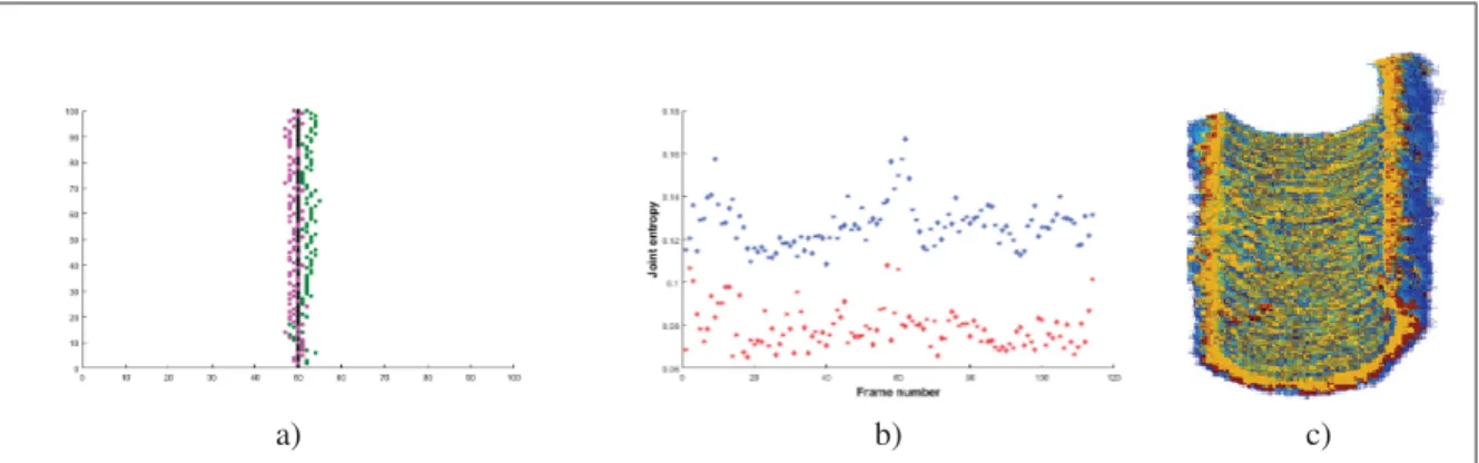 Figure 4.10 Patient 3: Motion correction of intracoronary OCT images: (a) shows the x-z projection of centerlines in green and purple before and after motion correction respectively compared against the ﬁxed straight line centered on the lumen of the ﬁrst 