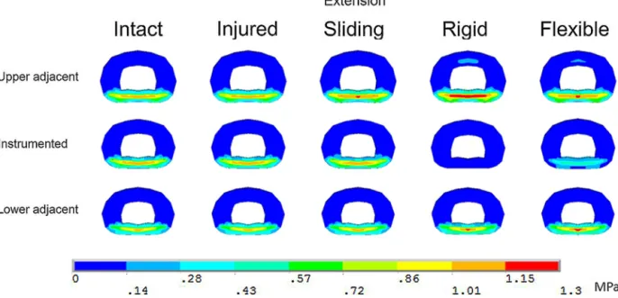 Fig. 6. Von Mises stress of the intervertebral disc in extension loading. Results are presented as an axial middle cut in the intervertebral disc.