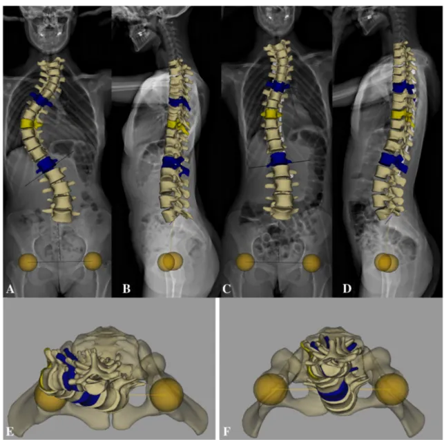 Fig. 3 Pre-operative and post-operative 3D reconstruction of a thoracic right convex scoliosis