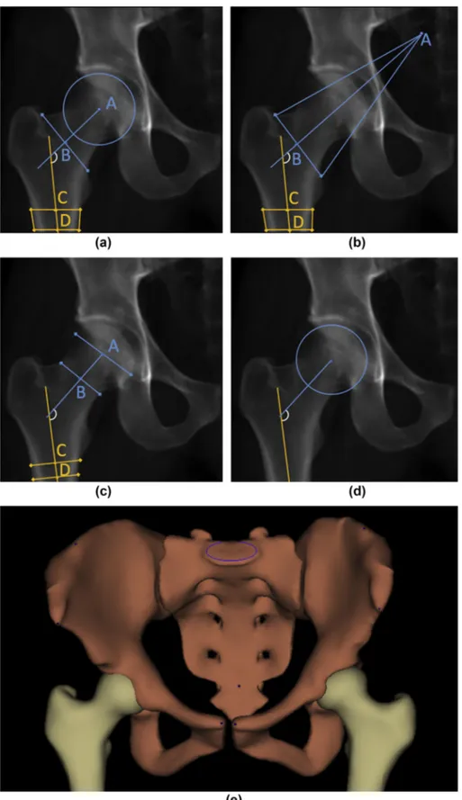 Figure 2 (a) Three-dimensional model of the pelvis and proximal femurs and the four different 2D methods of NSA measurement: (b) method 1;
