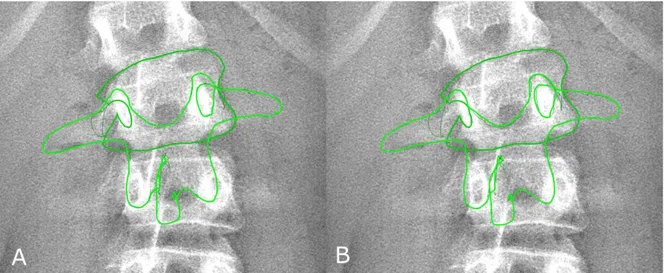 Fig. 2 Position of the vertebral model for apical vertebra (L2) before (panel A) and after manual adjustment