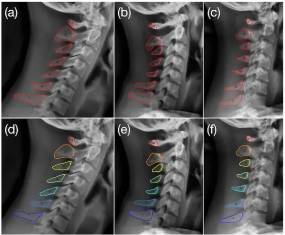 Fig.  3:  Spinous  processes  segmentation  examples  from  3  subjects  with  different  sizes  and  orientations