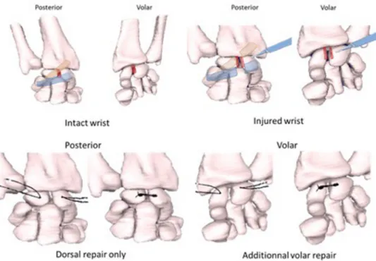 Fig. 3. Ligament injuries and repairs. Legend: Intact conﬁguration: Dorsal Radio Carpal (DRC) ligament in orange, Dorsal Intercarpal (DIC) ligament in blue, posterior and volar  part  of  the  SLIL  in  red