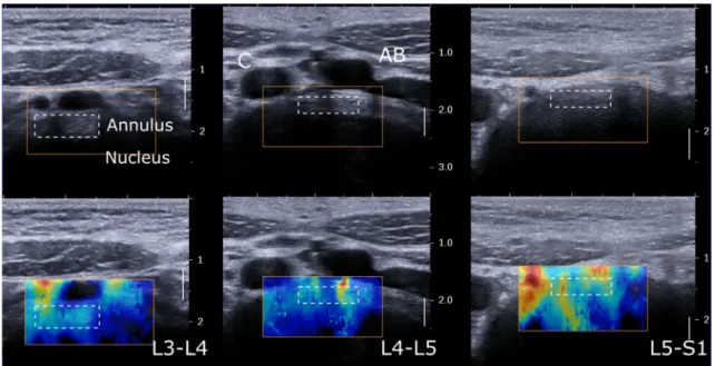 Fig. 1 Example of annulus fibrosus echography and shear wave elastography at L3-L4, L4-L5, and L5-S1 disc levels