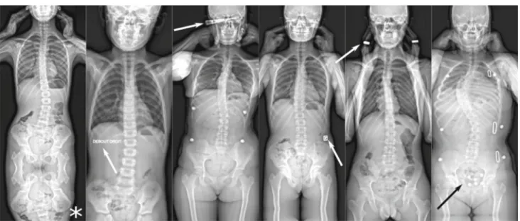 Fig. 3 Examples of incorrectly classified radiographs. Seven out of nineteen of the radiographs that were not correctly classified contained foreign objects, such as superimposed text or radiopaque buttons or jewellery (arrows)