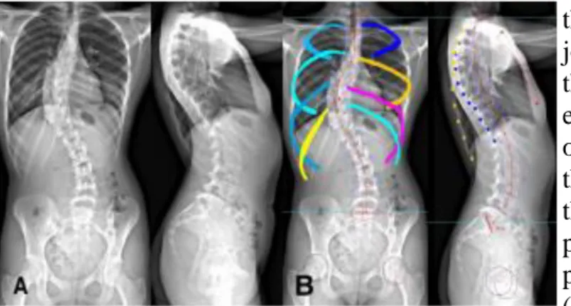 Figure  2:  A/  final  3D  reconstructions  B/  AP  and  lateral view showing perfect fit with the biplanar  X-ray 