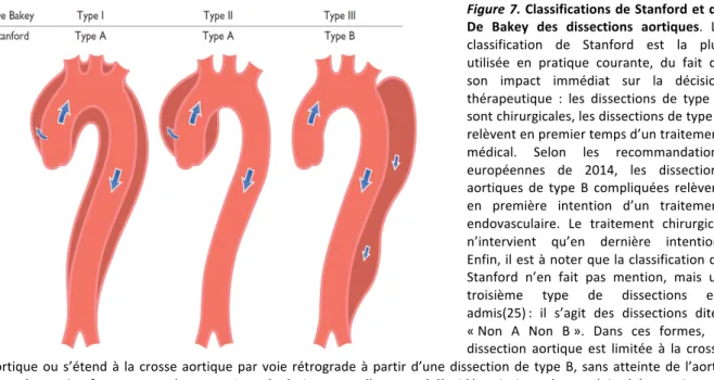 Figure 7. Classifications de Stanford et de  De  Bakey  des  dissections  aortiques.  La  classification  de  Stanford  est  la  plus  utilisée  en  pratique  courante,  du  fait  de  son  impact  immédiat  sur  la  décision  thérapeutique  :  les  dissect
