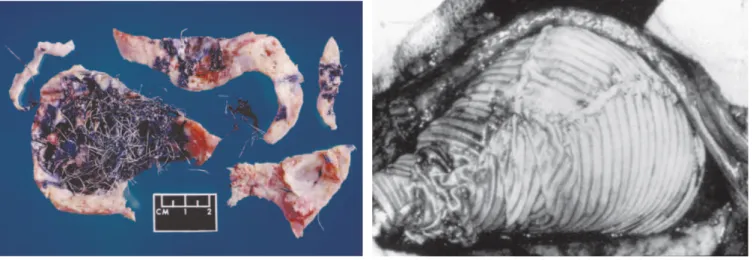 Figure 11. Deux illustrations de techniques décrites dans la réparation des anévrysmes aortiques