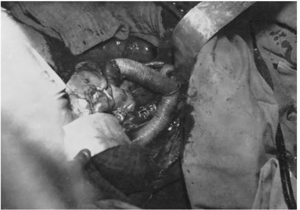 Figure  13.  Photographie  de  1959 :  Vue  en  fin  d’intervention  d’un  remplacement  total  de  la  crosse  aortique,  par  bi- bi-thoracotomie sous-costale