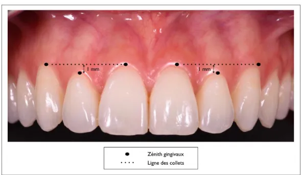 Figure 5 : Les zéniths gingivaux et la ligne des collets 