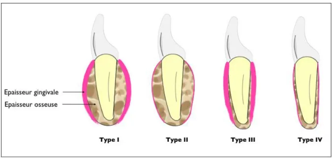 Figure 6 : Classification du morphotype parodontal selon Maynard et Wilson 