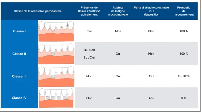 Tableau 1: Classification des récessions parodontales selon Miller modifiée par Zucchelli 