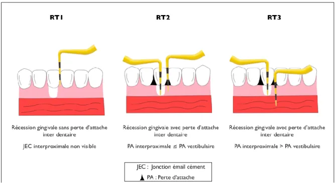 Figure 7 : Classification des récessions parodontales selon Cairo et al. 