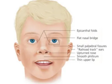 Figure 10 : Dysmorphies faciales causées par un SAF (37)