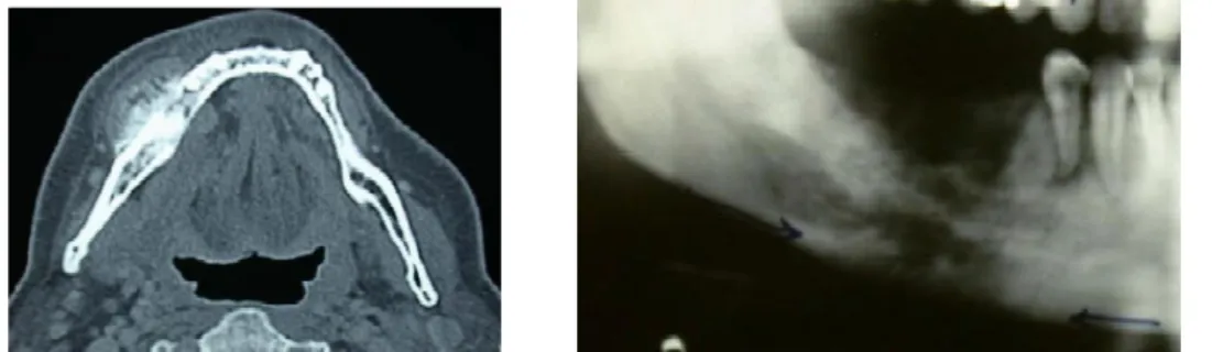 Figure 15 Ostéosarcome de la mandibule . Tomodensitométrie en coupe transversale : réaction périosté en « rayon  de soleil »