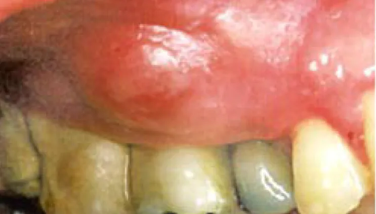 Figure 9     : abcès dentaire