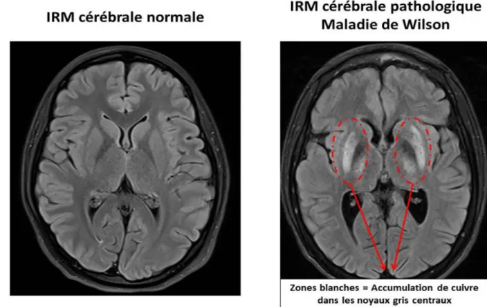Illustration 1: Imagerie en FLAIR de maladie de Wilson, coupe au niveau des putamens